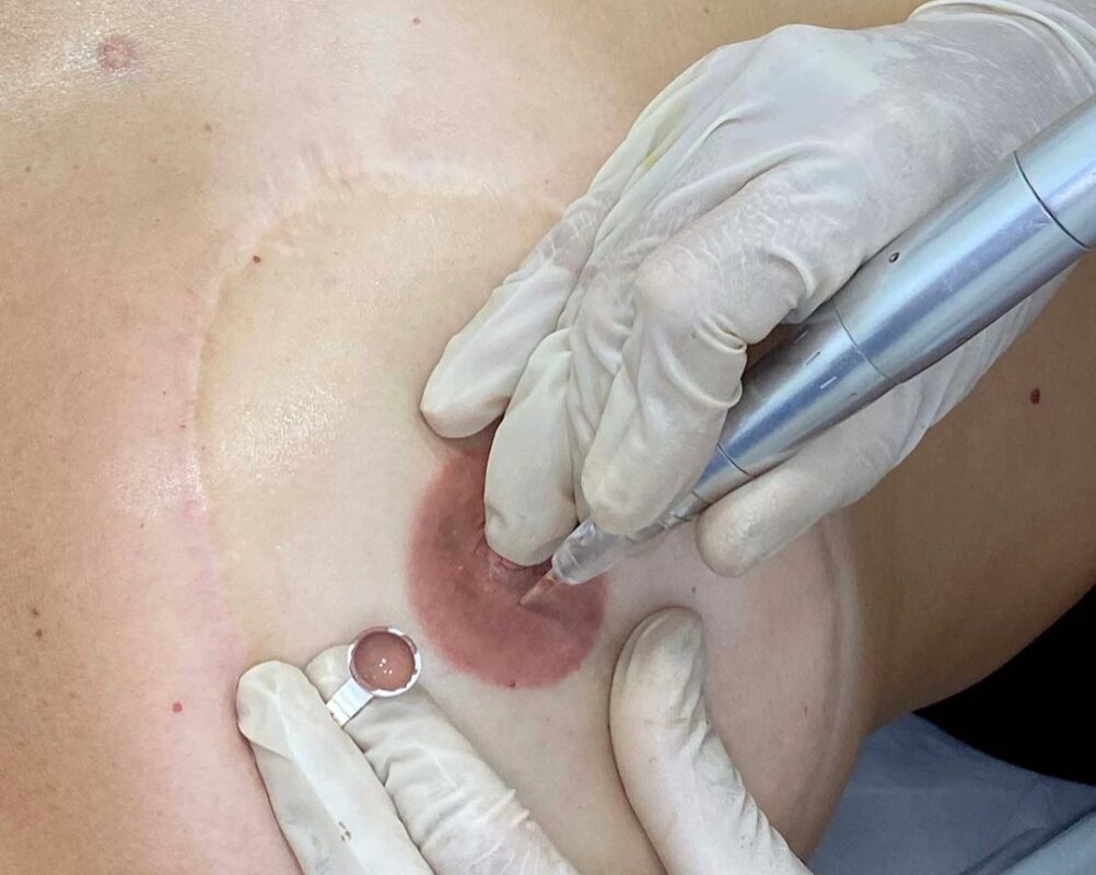 areola - 1