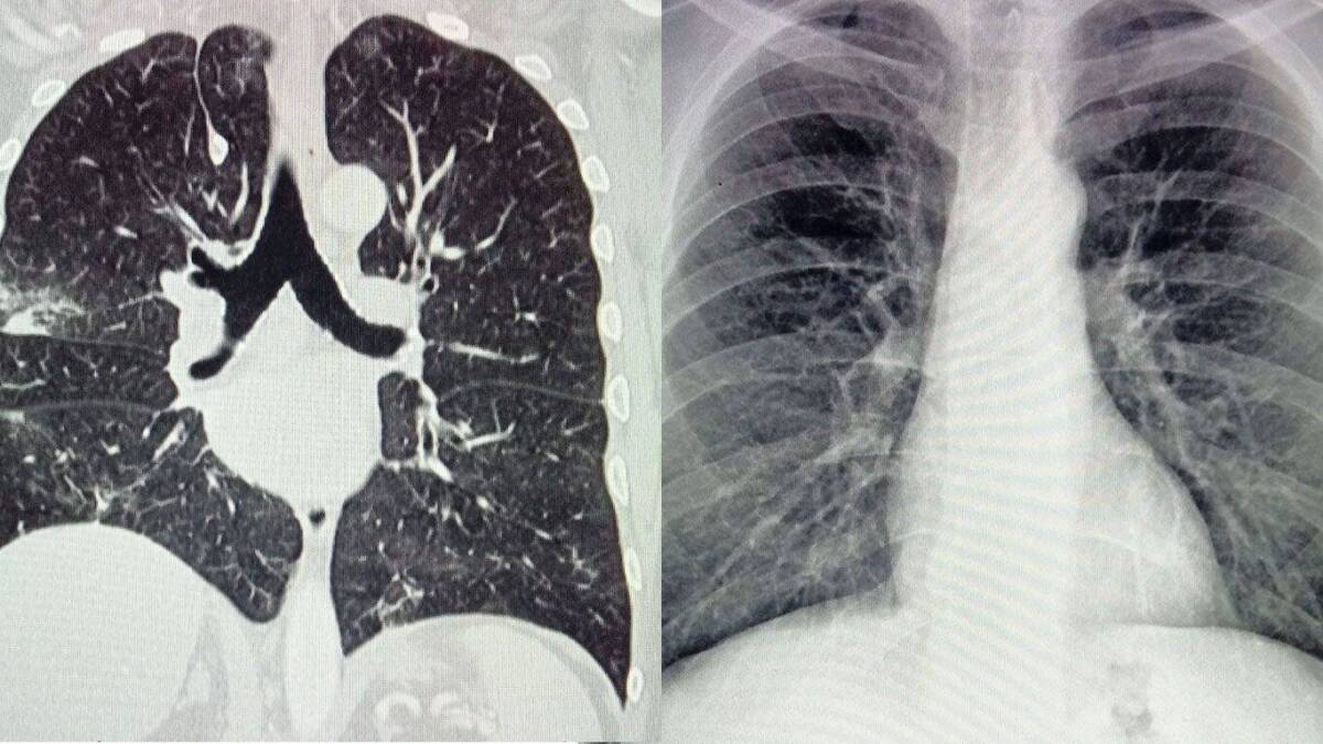 Cáncer de pulmón en no fumadores: una enfermedad en ascenso y difícil de detectar