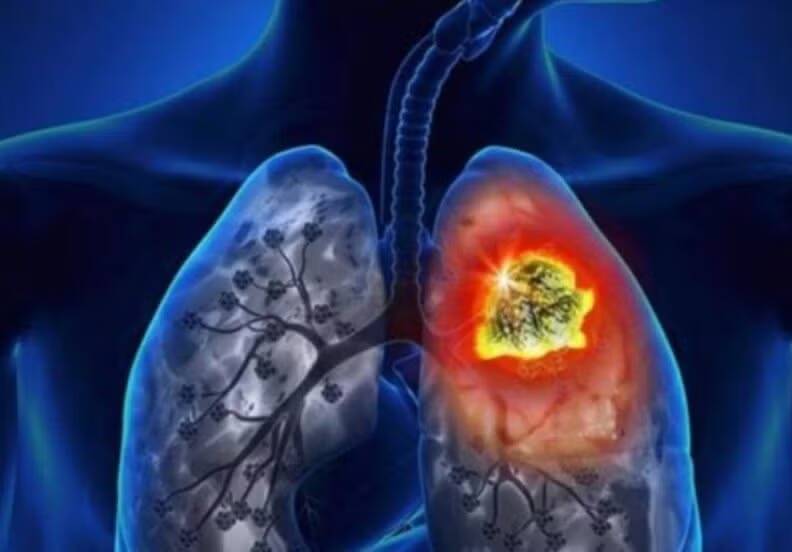 cancer pulmonar argentina - 6