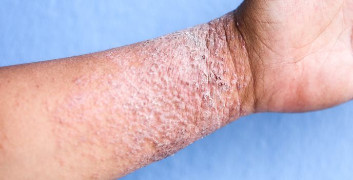 Denuncian maltrato e incumplimiento de ley en el hospital SAMIC de Oberá 2 Cobro ilegal y maltrato a un paciente con dermatitis atópica en el hospital SAMIC de Oberá