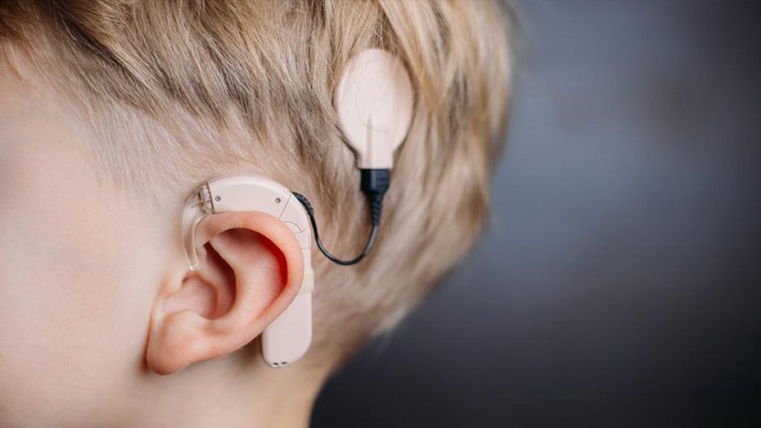 Cuatro niños de 3 a 7 años recibieron implantes cocleares en Corrientes 3 implante coclear dispositivo - 2