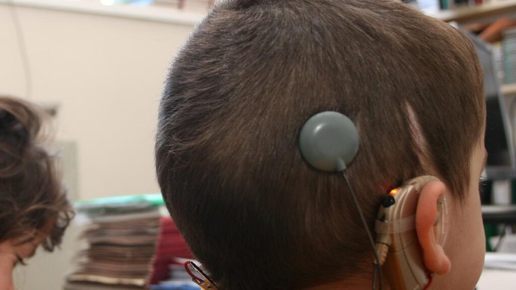 Cuatro niños de 3 a 7 años recibieron implantes cocleares en Corrientes 5 implantes cocleares2 - 4