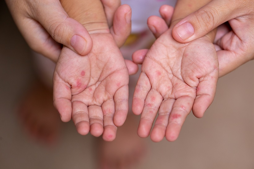Misiones descarta casos de sarampión y refuerza campaña de vacunación, según el director de Epidemiología 4 Alerta sarmpión: los casos se multiplicaron no solo en la Argentina en los últimos meses