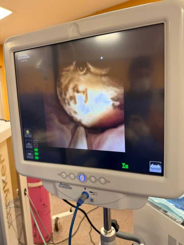 Avance en salud infantil: cirugía urológica mínimamente invasiva en el Hospital de Pediatría de Misiones 1 Durante la intervención, se utilizó el nuevo Intensificador de Imágenes recientemente incorporado al hospital Pediátrico, lo que permitió realizar la cirugía con mayor precisión y seguridad, gracias al control por radioscopía intraoperatoria.