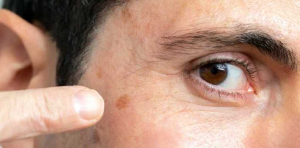 Cáncer de piel: insisten en la prevención y detección temprana cáncer de piel Misiones