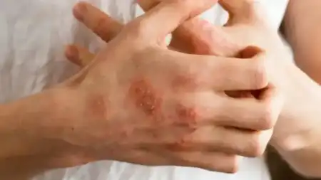 Campaña gratuita de detección de dermatitis atópica en Misiones: atención en Posadas y Oberá “No es solo una campaña de detección, también buscamos saber cómo están quienes ya tienen diagnóstico, si bajaron los brazos o si están desarrollando nuevas alergias”, explicó Silvia Fernández Barrio