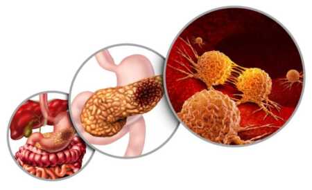 Misiones impulsa una ley para el abordaje integral del cáncer de páncreas cáncer de páncreas