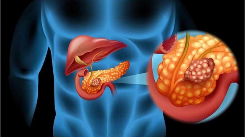 Misiones impulsa una ley para el abordaje integral del cáncer de páncreas 2 WhatsApp Image 2025 07 10 at 12.14.54 - 1