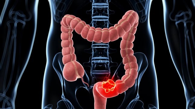 cáncer de colon