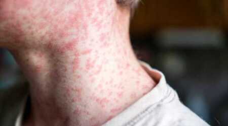 Paraguay confirma un caso de sarampión tras una década sin circulación del virus sarampion