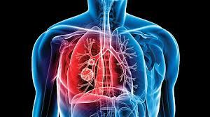 Ordenan internación compulsiva de 4 adultos con tuberculosis que contagiaron a menores en Misiones 7 tuberculosis1 - 6