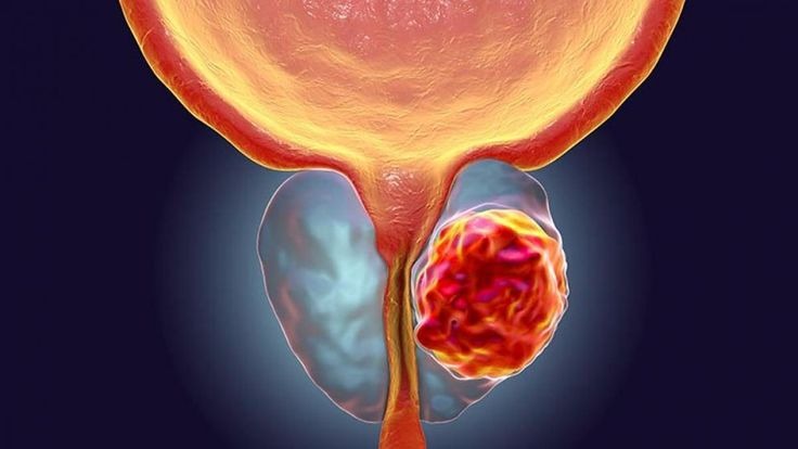 Cáncer de próstata: cuándo y por qué es clave la detección temprana 2 Cáncer
