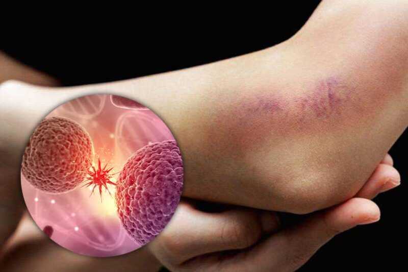 Leucemia mieloide crónica: “Todos los pacientes acceden al tratamiento sin costo“ 4 Leucemia OK - 3