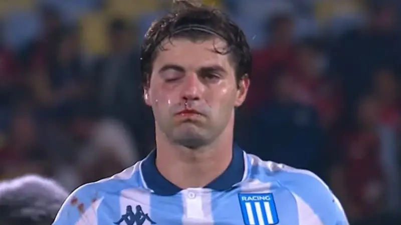 Preocupación en Racing: Santiago Sosa sufrió la fractura del maxilar y se pierde la vuelta 2 WhatsApp Image 2025 10 23 at 11.24.14 - 1