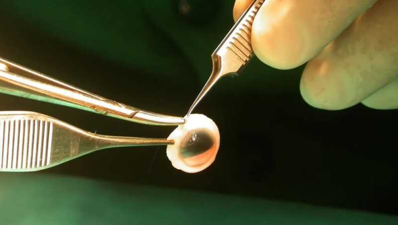 donacion de corneas 3 - 4