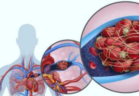 Misiones trabaja en una ley para el abordaje integral de patologías venosas enfermedades venosas 1 - 2