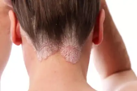 Psoriasis: entre el aumento de cuadros severos y avances clave en medicamentos biológicos psoriasis