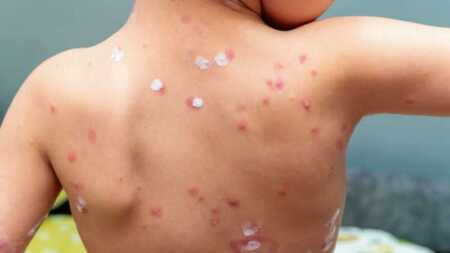 Once casos de varicela en una escuela posadeña vuelve a poner en alerta el bajo nivel de vacunación obligatoria varicela salud pública