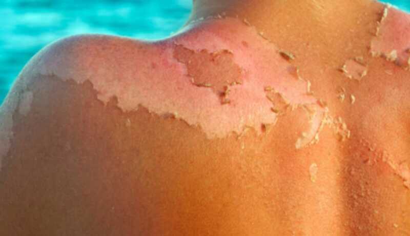 Cáncer y verano: cómo proteger la piel durante el tratamiento oncológico y evitar complicaciones 3 verano