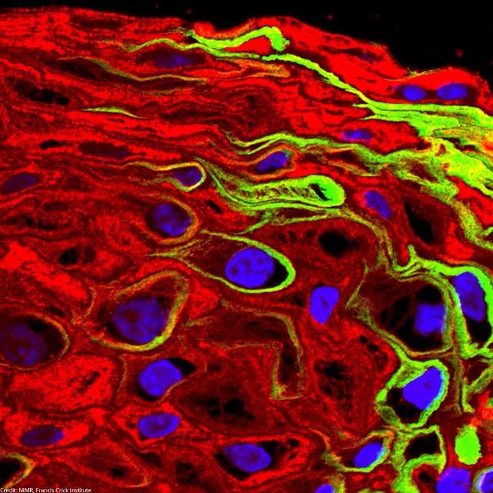 Cáncer colorrectal: la advertencia del premio Nobel que pone en foco la carne vacuna 5 Glvw4YHXIAACroF - 4