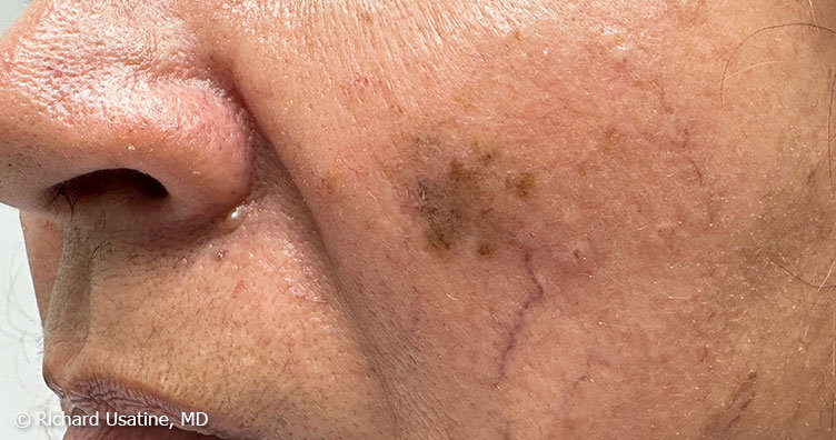 Cáncer y sol: claves para proteger la piel durante el verano y evitar riesgos en tratamientos oncológicos 4 cancer piel1 - 3