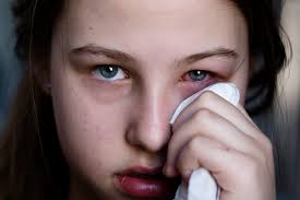 Conjuntivitis en verano: cómo se contagia, qué síntomas alertan y riesgo en la pileta 3 conjuntivitis