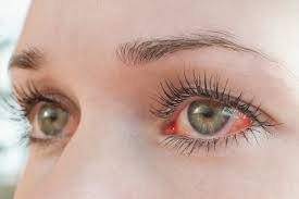 Conjuntivitis en verano: cómo se contagia, qué síntomas alertan y riesgo en la pileta 5 conjuntivitis alergica - 4