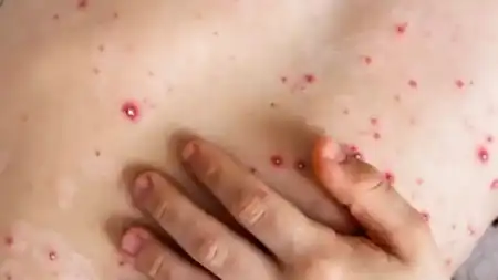 viruela