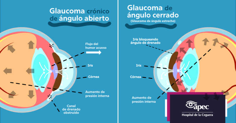 Glaucoma: la enfermedad silenciosa que ya afecta a más de un millón de argentinos 2 Glaucoma