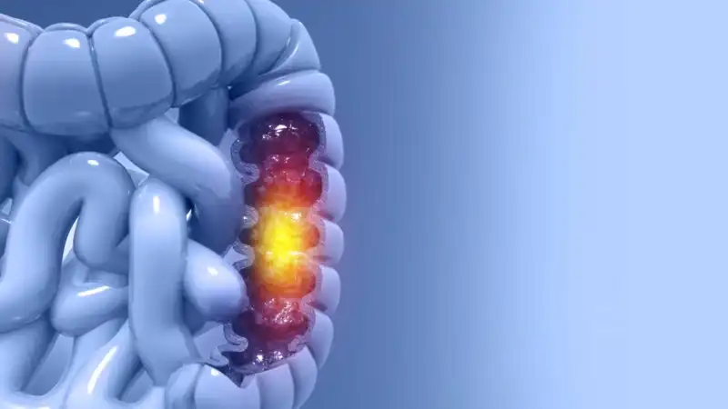 Cáncer de colon en Argentina: baja tasa de testeo y la detección temprana como herramienta clave para reducir la mortalidad 2 Especialistas advierten que aumentar los controles podría reducir significativamente la mortalidad por cáncer de colon.