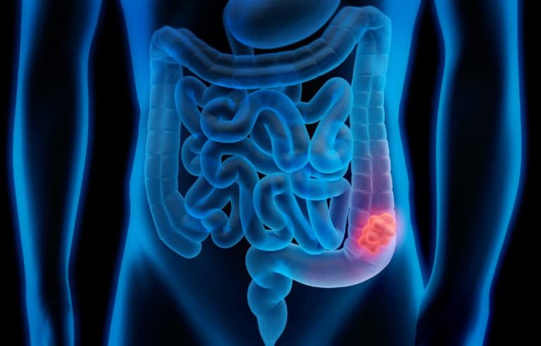 Cáncer de colon en Argentina: baja tasa de testeo y la detección temprana como herramienta clave para reducir la mortalidad 1 Solo 3 de cada 10 personas en riesgo se realizan estudios preventivos de cáncer colorrectal en el país.