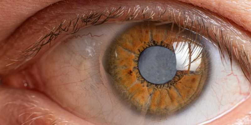 El glaucoma es una enfermedad ocular silenciosa que daña el nervio óptico y puede provocar pérdida de visión si no se detecta a tiempo.