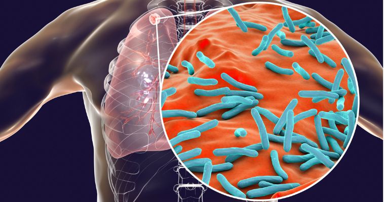 La tuberculosis continúa siendo una de las principales enfermedades infecciosas a nivel global, con millones de casos y muertes cada año.