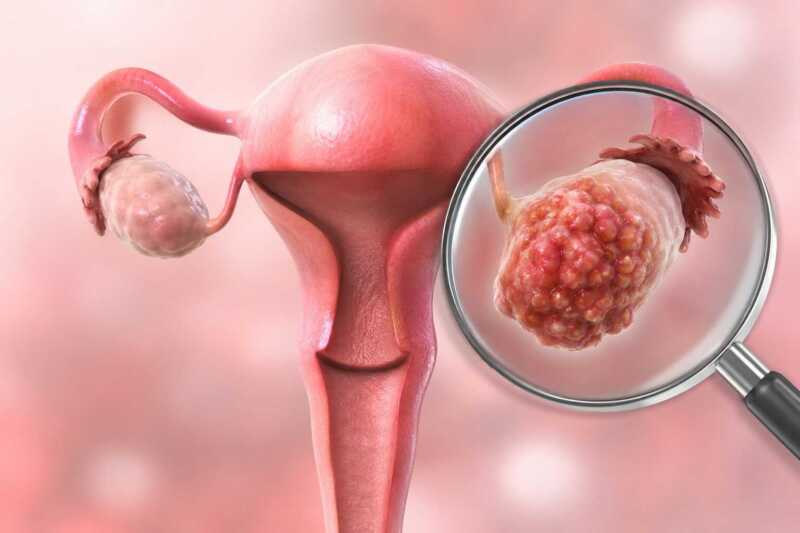El 70% de los casos del cáncer de ovario se diagnostica en etapas avanzadas El cáncer de ovario continúa siendo uno de los tumores ginecológicos con mayor mortalidad debido a la dificultad para detectarlo en etapas tempranas.