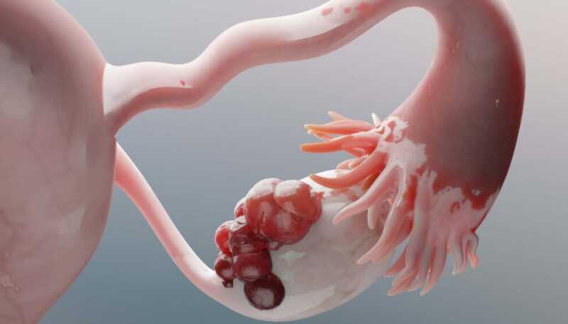 El 70% de los casos del cáncer de ovario se diagnostica en etapas avanzadas 1 Especialistas advierten que síntomas persistentes como hinchazón abdominal o dolor pélvico no deben ser ignorados.