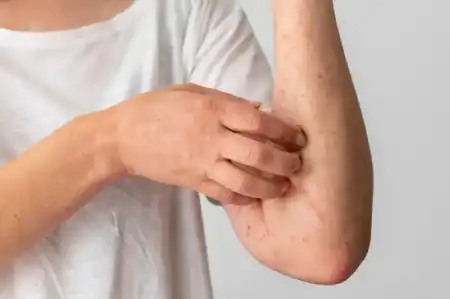 Alergias alimentarias