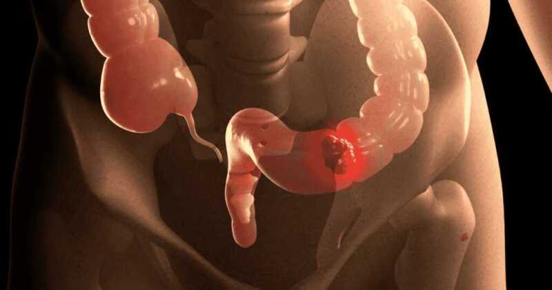 Cáncer colorrectal: crecen los diagnósticos en América Latina y refuerzan el llamado a la detección temprana Cancer colorrectal 1 1024x538 1 - 2