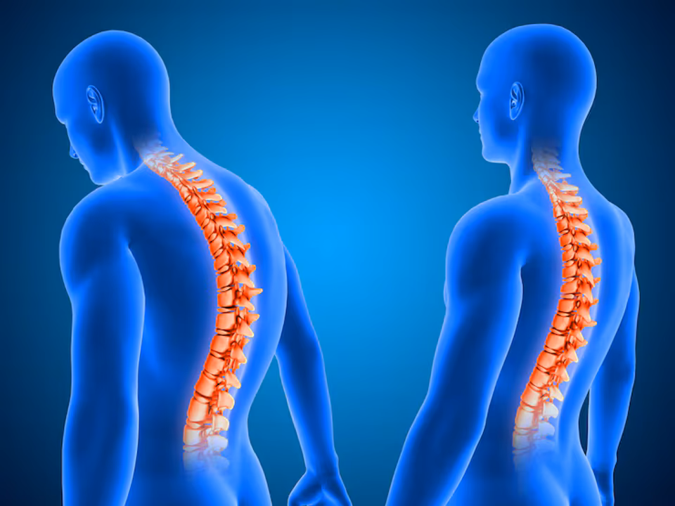 Escoliosis: especialistas advierten que afecta al 4% de los niños y destacan la importancia de la detección temprana 4 Escoliosis - 3