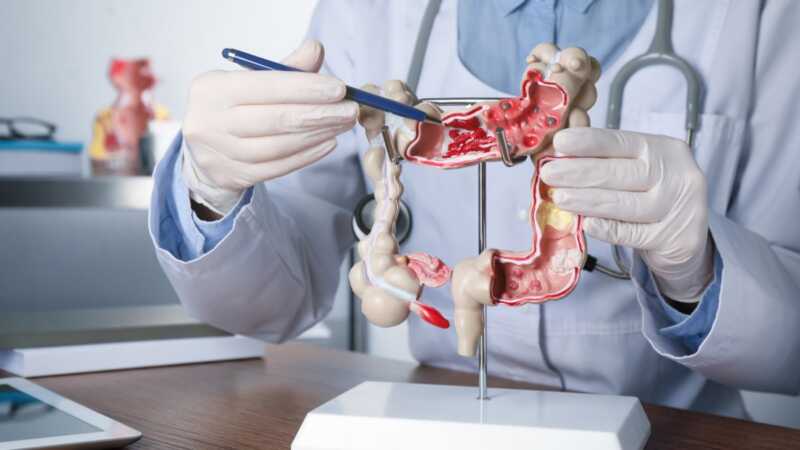 Cáncer colorrectal: crecen los diagnósticos en América Latina y refuerzan el llamado a la detección temprana 4 colon model 1200x675 1 - 3