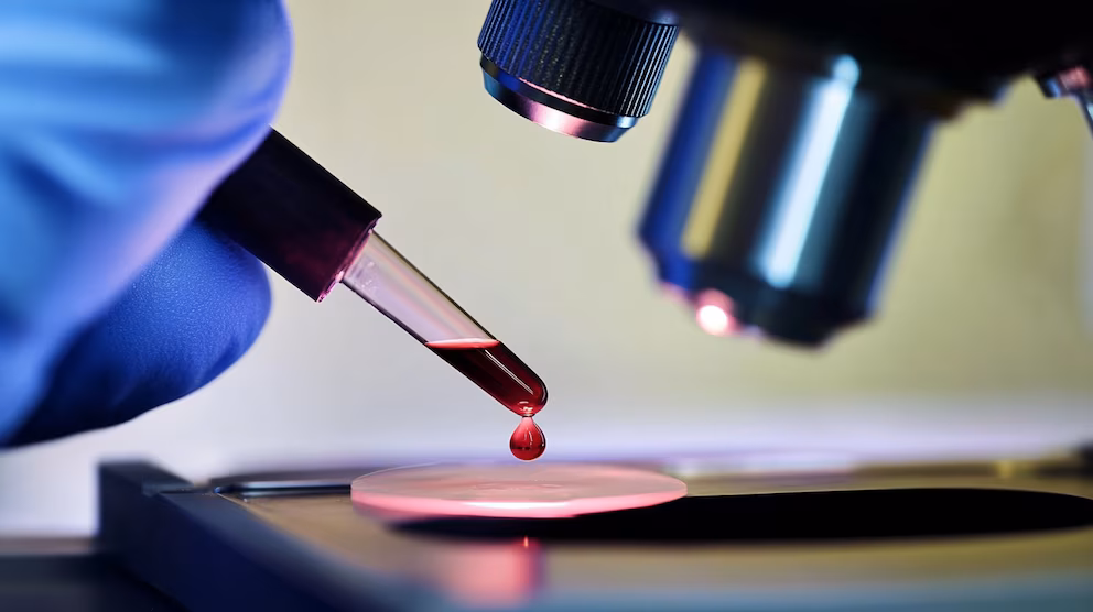 Un análisis de sangre podría predecir complicaciones tras un infarto grave