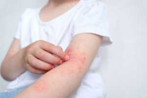 Dermatitis