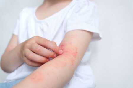 Dermatitis