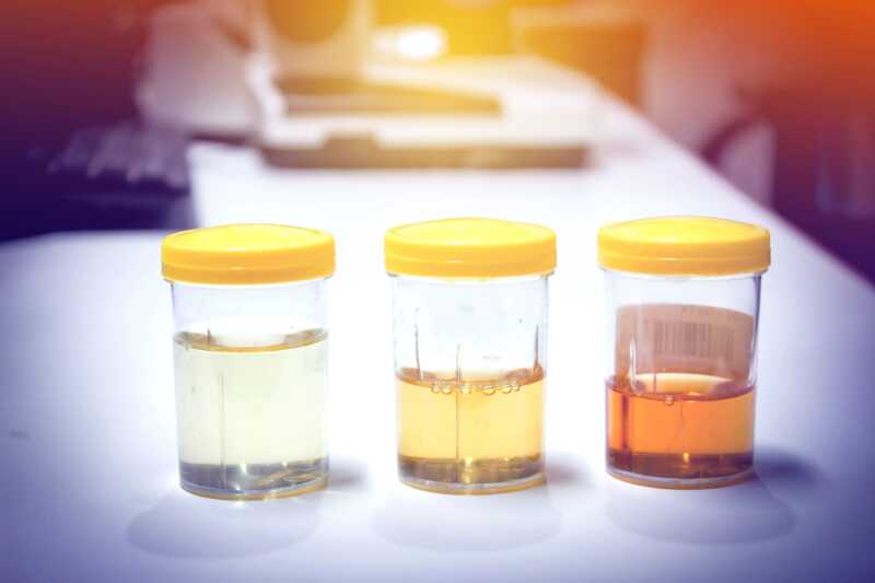 Qué significa el color de la orina y cuándo puede ser una señal de alerta Color