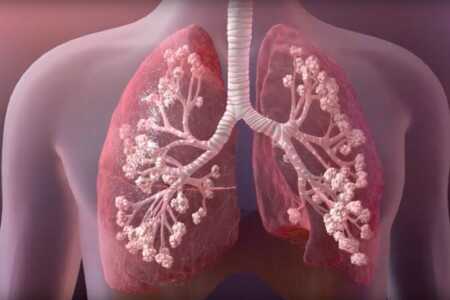 Fibrosis quística: estudios pediátricos respaldan la eficacia de una triple terapia moduladora Fibrosis - 2
