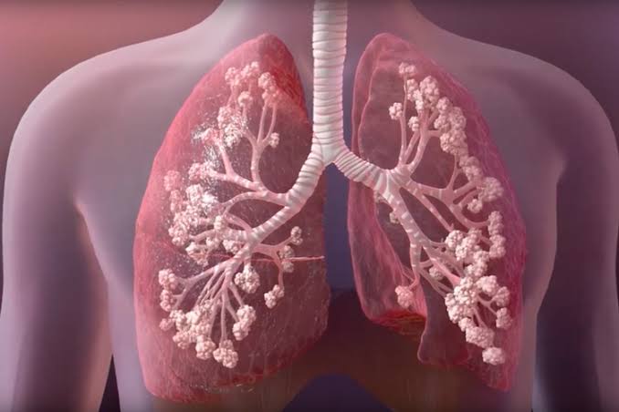 Fibrosis quística: estudios pediátricos respaldan la eficacia de una triple terapia moduladora Fibrosis - 2