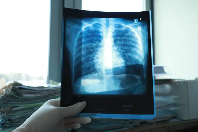 Fibrosis Pulmonar: una patología que afecta la funcionalidad de los pulmones y alerta a los pacientes 2 La fibrosis pulmonar puede avanzar durante años sin un diagnóstico preciso. Cuáles son sus principales síntomas, cuántas personas podría afectar en Argentina y por qué la detección temprana es clave.